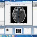 brain tumor detection in matlab